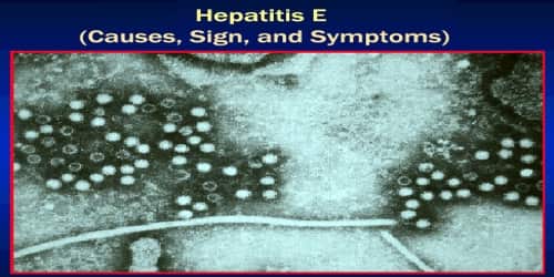 Hepatitis E (Causes, Sign, and Symptoms)