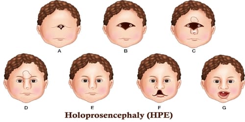 Holoprosencephaly Assignment Point
