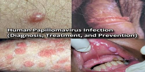 Human Papillomavirus Infection (Diagnosis, Treatment, and Prevention)