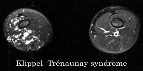 Klippel–Trénaunay Syndrome (KTS)