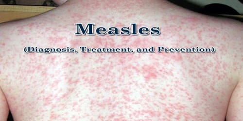 Measles (Diagnosis, Treatment, and Prevention)