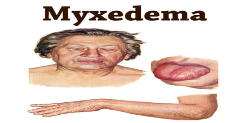 Myxedema
