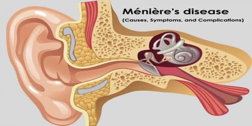 Ménière’s disease (Causes, Symptoms, and Complications)
