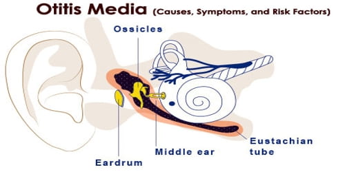 Otitis Media (Causes, Symptoms, and Risk Factors)