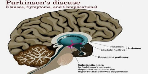 Parkinson’s disease (Causes, Symptoms, and Complications)