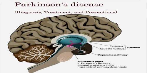 Parkinson’s disease (Diagnosis, Treatment, and Preventions)