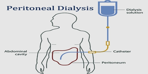 Peritoneal Dialysis