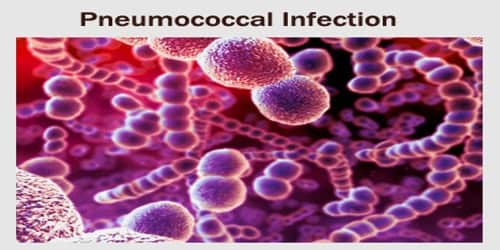 Pneumococcal Infection