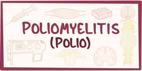 Poliomyelitis (Vaccine, Diagnosis, Treatment and Prevention)