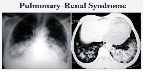 Pulmonary-Renal Syndrome
