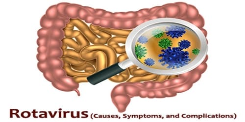 Rotavirus (Causes, Symptoms, and Complications)
