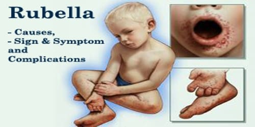 Rubella (Causes, Symptom and Complications)