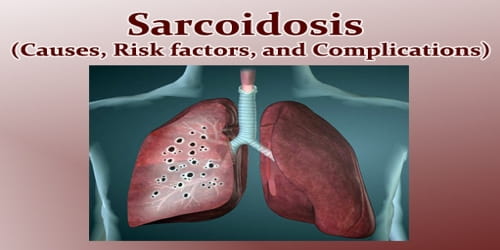 Sarcoidosis (Causes, Risk factors, and Complications)