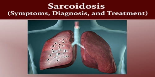 Sarcoidosis (Symptoms, Diagnosis, and Treatment)