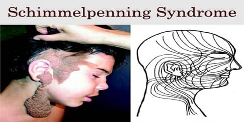 Schimmelpenning Syndrome