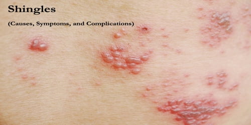 Shingles (Causes, Symptoms, and Complications)