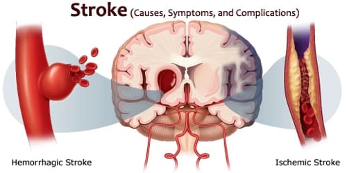 Stroke (Causes, Symptoms, and Complications)