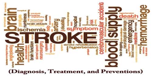 Stroke (Diagnosis, Treatment, and Preventions)