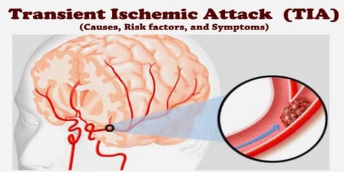 Transient Ischemic Attack (Causes, Risk factors, and Symptoms)