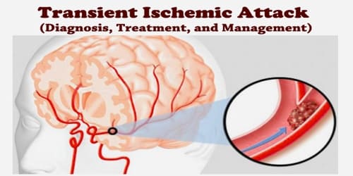 Transient Ischemic Attack (Diagnosis, Treatment, and Management)