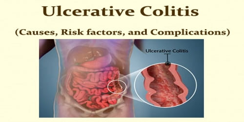 Ulcerative Colitis (Causes, Risk factors, and Complications)