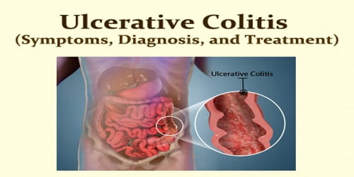 Ulcerative Colitis (Symptoms, Diagnosis, and Treatment)