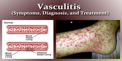Vasculitis (Symptoms, Diagnosis, and Treatment)