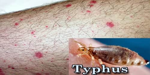 About Typhus