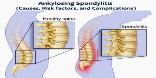 Ankylosing Spondylitis (Causes, Risk factors, and Complications)