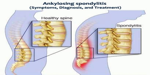Ankylosing spondylitis (Symptoms, Diagnosis, and Treatment)