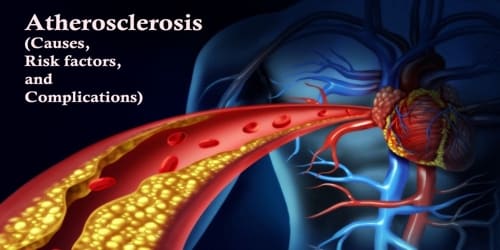 Atherosclerosis (Causes, Risk factors, and Complications)