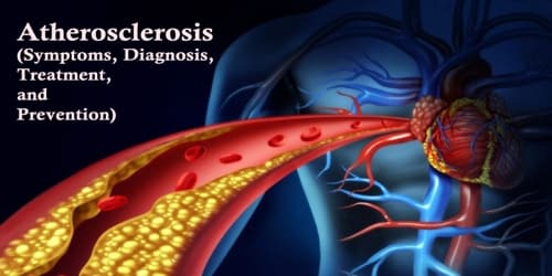 Atherosclerosis (Symptoms, Diagnosis, Treatment, and Prevention)