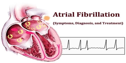 Atrial Fibrillation (Symptoms, Diagnosis, and Treatment)