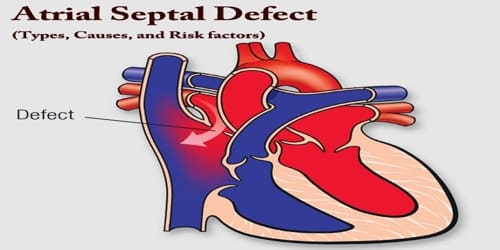 Atrial Septal Defect (Types, Causes, and Risk factors)