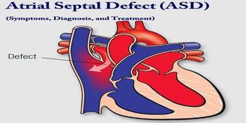 Atrial septal defect (Symptoms, Diagnosis, and Treatment)