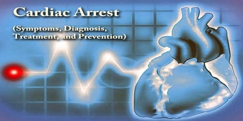 Cardiac Arrest (Symptoms, Diagnosis, Treatment, and Prevention)