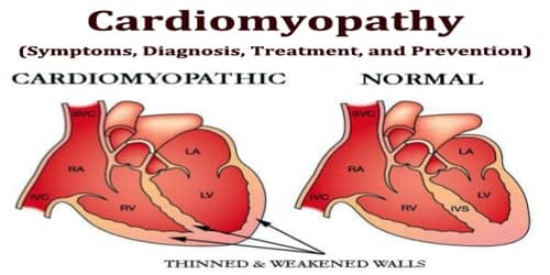 Cardiomyopathy (Symptoms, Diagnosis, Treatment, and Prevention)