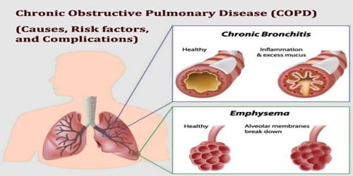 Chronic Obstructive Pulmonary Disease (Causes, Risk factors, and Complications)