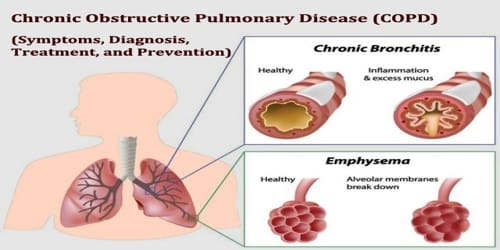 Chronic Obstructive Pulmonary Disease (Symptoms, Diagnosis, Treatment, and Prevention)