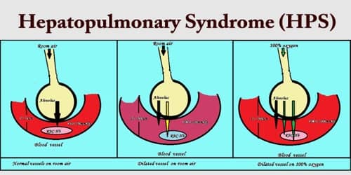Hepatopulmonary Syndrome (HPS)