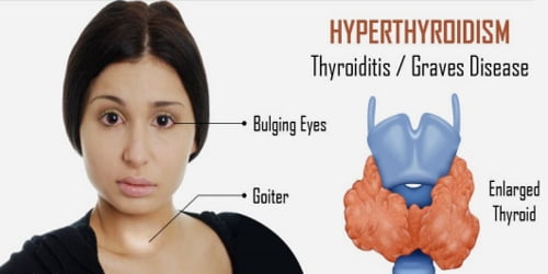 Hyperthyroidism (Symptoms, Diagnosis, and treatment)
