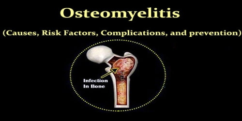 Osteomyelitis (Causes, Risk Factors, Complications, and prevention)
