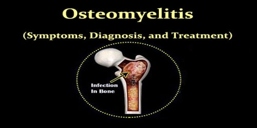 Osteomyelitis (Symptoms, Diagnosis, and Treatment)