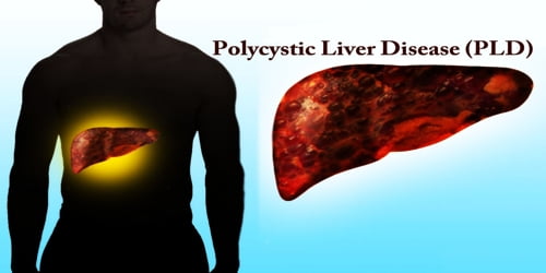 Polycystic Liver Disease (PLD)
