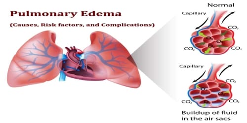 Pulmonary Edema (Causes, Risk factors, and Complications)