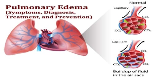 Pulmonary Edema (Symptoms, Diagnosis, Treatment, and Prevention)