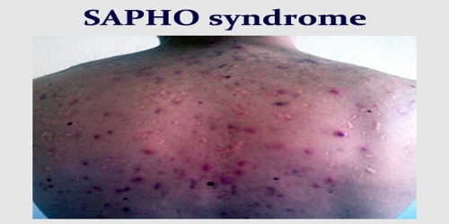 SAPHO syndrome