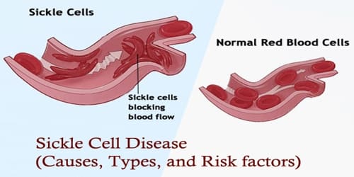 Sickle Cell Disease (Causes, Types, and Risk factors)