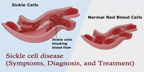 Sickle cell disease (Symptoms, Diagnosis, and Treatment)