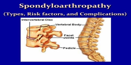 Spondyloarthropathy (Types, Risk factors, and Complications)